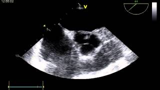 LVAD Procedure  Left Ventricular Assist Device  Heart Failure Treatment  Max Hospital [upl. by Treharne]