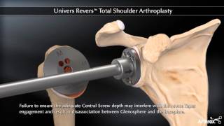 Univers Revers™ Total Shoulder Arthroplasty [upl. by Carew522]