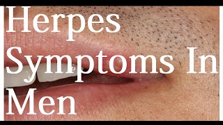 Herpes Symptoms In Men [upl. by Schroeder807]