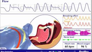 Understanding Sleep Disordered Breathing [upl. by Gelya]