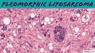 Well differentiated liposarcoma with BIZARRE pleomorphic lipoblasts 5Minute Pathology Pearls [upl. by Beitz396]