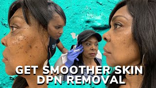 DPN removal for smoother skin [upl. by Schultz214]