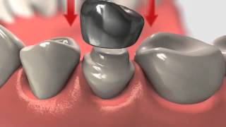 Dental Crown  Crowns And Root Canal Treatment [upl. by Ramej474]