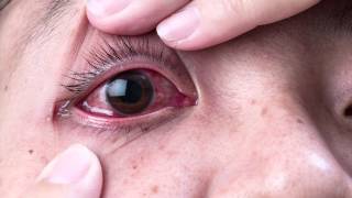 STYE TREATMENT How to treat a stye in your eye What to do amp biggest MISTAKES from your eye doctor [upl. by Laerol]