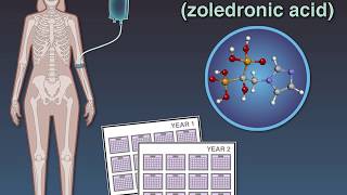 Zoledronate in Osteopenia [upl. by Ellehc]