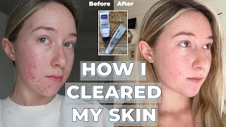 Adapalene Gel amp Benzoyl Peroxide transformation  skincare routine  HOW I CLEARED MY SKIN [upl. by Enyrehtac853]