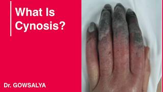 What is Cyanosis [upl. by Tracy]