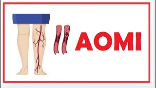 AOMI arteriopathie obliterante des membre inferieure [upl. by Akiner80]