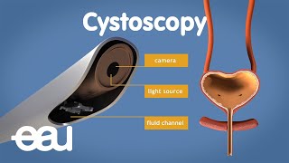 Cystoscopy overactive bladder [upl. by Ailat]