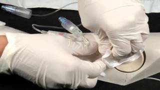 Chapter 8  PICC Catheter Removal [upl. by Kacie]