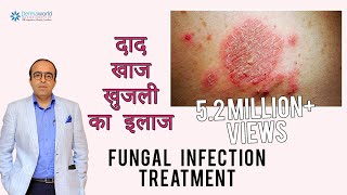 फ़ंगस इनफ़ेक्शन दिनाय दाद खाज का इलाज  Treating Fungal Infection In HINDI  Dr Rohit Batra [upl. by Luci]