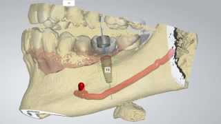 Digital Implant Dentistry [upl. by Assital931]