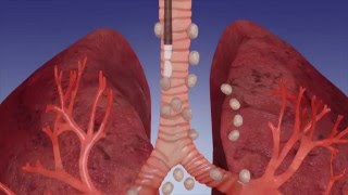 EBUS Procedure OverviewOlympus Bronchoscopy [upl. by Nyrtak]