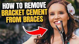 How to Remove Bracket Cement from Braces [upl. by Mullins355]