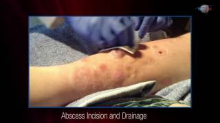 WCW Abscess Incision and Drainage [upl. by Najram]