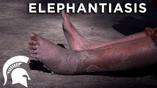 Spartans fight elephantiasis in Tanzania [upl. by Cheria]