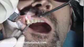 Sinus Lift Procedure and Dental Implant Placement Surgery [upl. by Annairol]