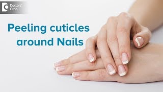 What to do for peeling cuticles around nails  Dr Rasya Dixit  Doctors Circle [upl. by Elane]