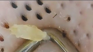 Big Old Blackhead Removal Video [upl. by Oedama222]