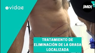 Cómo eliminar la grasa localizada [upl. by Efram523]