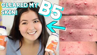 How I Cleared my Skin with Pantothenic acid B5 Acne Gone [upl. by Cordie703]