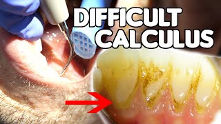 How To Remove Difficult amp Tenacious Calculus Tartar [upl. by Trever]