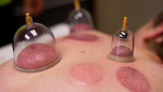 First experience with cupping therapy [upl. by Lainahtan668]