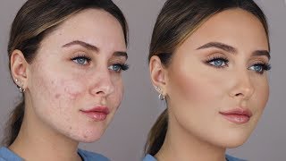 HOW TO COVER ACNE SCARS easy amp non cakey [upl. by Kelsey]