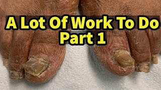 Severe Fungal Fungus Toenails A Lot Of Work To Do Part 1 [upl. by Olgnaed]