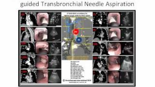 EBUSCTBronchoscopy Poster [upl. by Isadora]