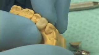 Fabricating Provisional Crowns [upl. by Harilda]