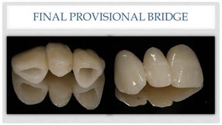 Dental Bridge The Esthetic Provisional Bridge [upl. by Khai265]