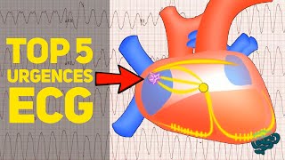 🔴 Le TOP 5 des Urgences à lEcg EXPLIQUÉES CLAIREMENT  ​ [upl. by Dougal898]