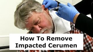 Removing Impacted Cerumen from a Patients Ear [upl. by Harl]