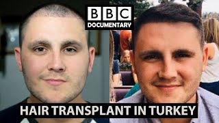 Hair Transplant Turkey  BBC Documentary  Paul Before amp After [upl. by Onitsuj119]