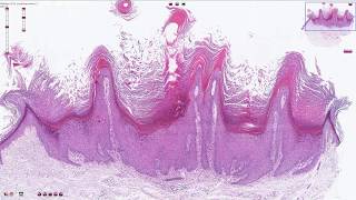 Verruca Vulgaris  Histopathology [upl. by Budwig]