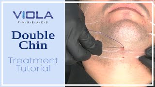 Viola Threads Double Chin Treatment Tutorial [upl. by Lolly629]