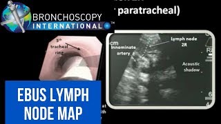 Ultrasound Guided Breast Biopsy Eskenazi HospitalEnglish version [upl. by Drue]