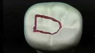 Endodontic Cavity Preparation  Phase I  Posterior [upl. by Maje]