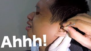 Top 5 Causes of Itchy Ears and Treatment Too [upl. by Melva615]