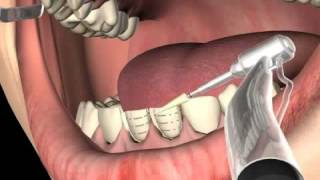 What are Dental Veneers [upl. by Ruyam]