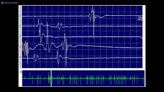 Cardiac arrest rhythms VF VT Asystole and PEA [upl. by Marcia]