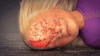 CoupContrecoup Brain Injury Animation [upl. by Yle]