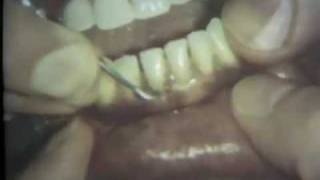 Scaling and Root Planing Part II Mandibular Teeth [upl. by Adai]