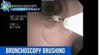 Advanced Bronchoscopy for Lung Diagnosis [upl. by Gabrielson663]