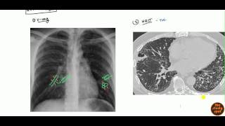 What Is Bronchitis [upl. by Nylicaj964]