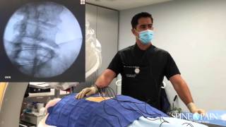 Radiofrequency Ablation Procedure [upl. by Glanti]