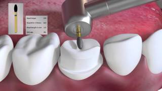 Crown preparation tutorial by Prof Brian Millar [upl. by Shepp]