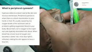 Peripheral Cyanosis  Practical viva  Clinical [upl. by Serg]