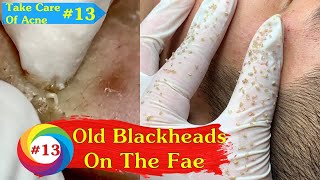 Old Blackheads In The Mans Face  Care Of Acne Treatment 13 [upl. by Tnerual]